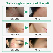 Scar Removal Cream
